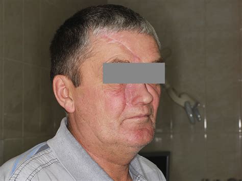 Искусственный силиконовый нос: протез носа Эпитетика