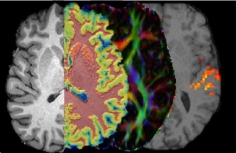 Structural and functional brain MRI: overview of image analysis methods – Medical Image Analysis ...