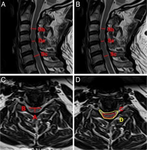 Frontiers Are Surgical Outcomes For One Level Anterior Decompression