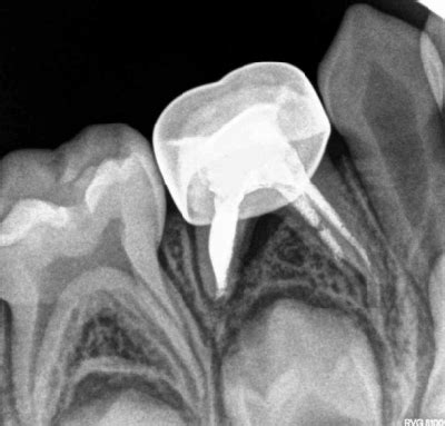 Six Month Follow Up Radiograph Showing Progressive Resolution Of The