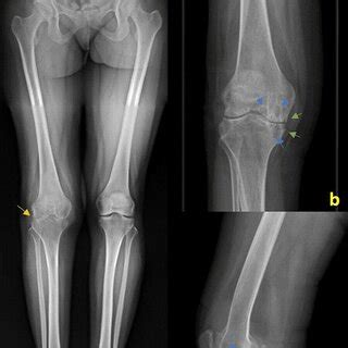 Lower Limb X Rays A Lower Limb B Anteroposterior And C Lateral