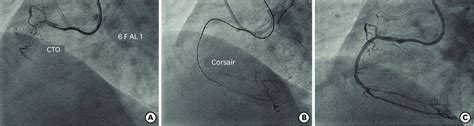 A Engagement Of Rca Ostium With 6 F Al 1guide Catheter To Address Cto