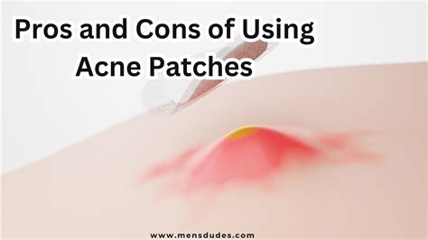 Everything You Need To Know About Acne Patches