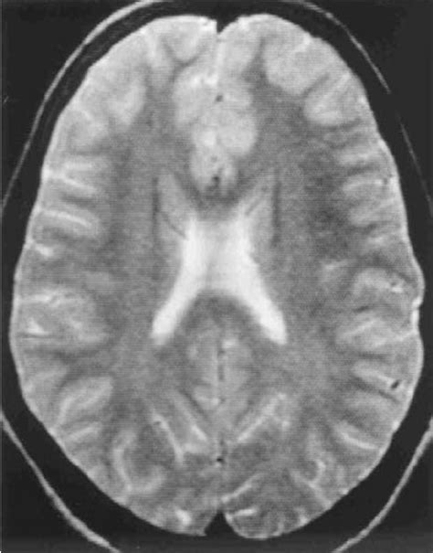 Normal Imaging In A Child With Acute Hypertensive Encephalopathy T 2