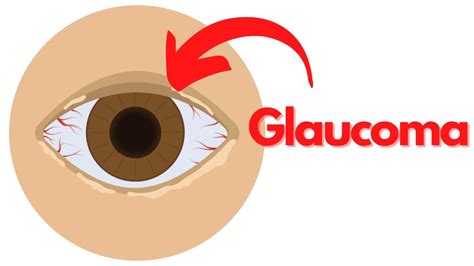 What Is Glaucoma Symptoms Causes Treatment Prevention Youtube