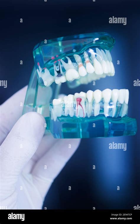 Teeth Decay Dentistry Model Showing Caries In Tooth Stock Photo Alamy