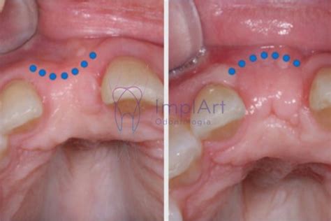 Enxerto Osseo Dental Antes E Depois Kb Implart