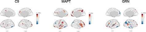 Subcortical Deformation Is Uniquely Related To Cortical Thickness Among