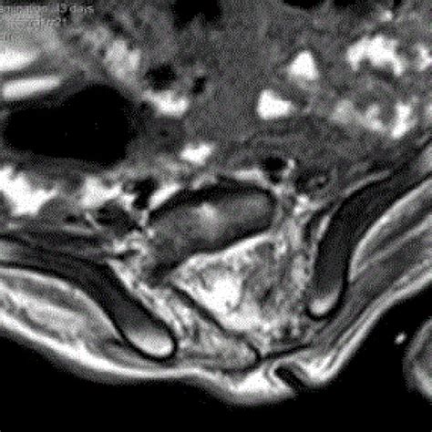 Hypertrichosis Of The Back And Sacral Dimple Download Scientific Diagram