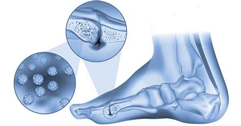 4 Causas Que Dan Lugar A Osteomielitis Infección De Huesos En Los