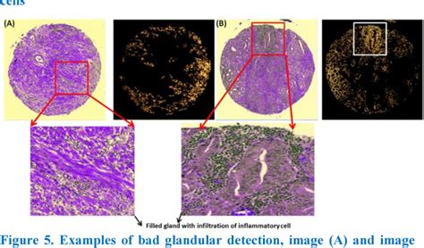 Figure 4 From Automated Prostate Glandular And Nuclei Detection Using