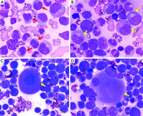 Photomicrograph Of The Bone Marrow Aspirate Wright Giemsa Stain Download Scientific Diagram