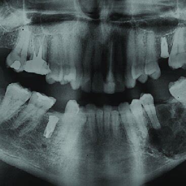 Panoramic Radiograph Multilocular Image Located At The Left