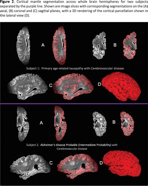 Deep Learning Pipeline For Cortical Gray Matter Segmentation And