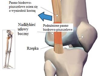 Kolano biegacza ból z boku kolana przyczyny leczenie Sport Med