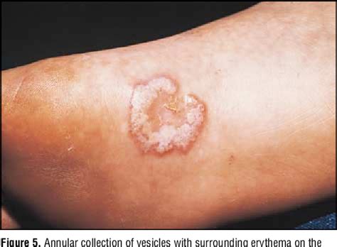 [pdf] Inflammatory Tinea Pedis Manuum Masquerading As Bacterial Cellulitis Semantic Scholar