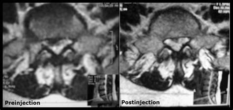 Axial MRI images showing postero-lateral L5-S1 disc protrusion which... | Download High-Quality ...