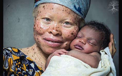 Albinos En Frica Mira C Mo Una Fot Grafa Quiere Devolverles La