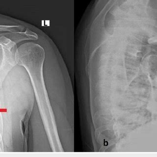 Anteroposterior A And Transthoracic B Shoulder X Rays Did Not