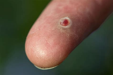 Pyogenic Granuloma On A Finger Stock Photo Download Image Now