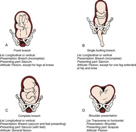 Shoulder Presentation