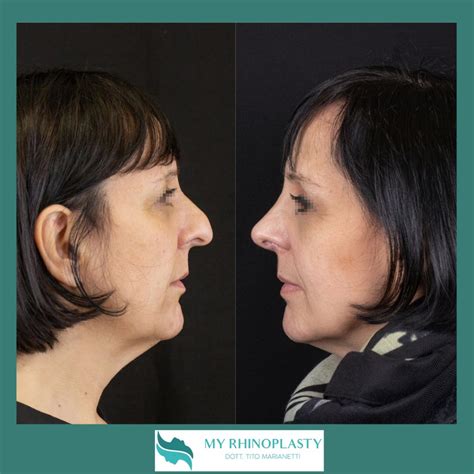 Naso Rifatto Prima E Dopo Casi Di Rinoplastica My Rhinoplasty