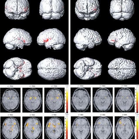 Olfactory Functional Magnetic Resonance Imaging Fmri Activation Maps