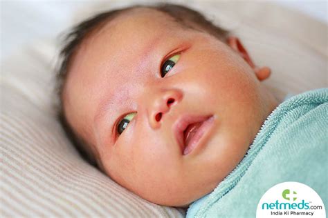 Newborn Jaundice Causes Symptoms And Treatment Netmeds