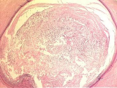 Epidermal Inclusion Cyst Histology