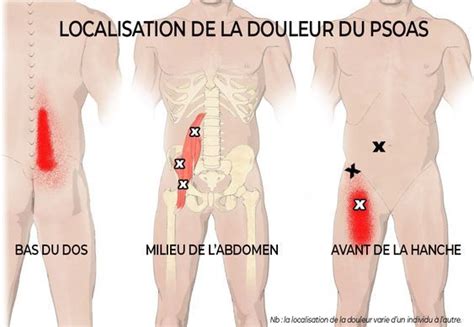 Douleur du psoas signification symptômes et traitement Yoga