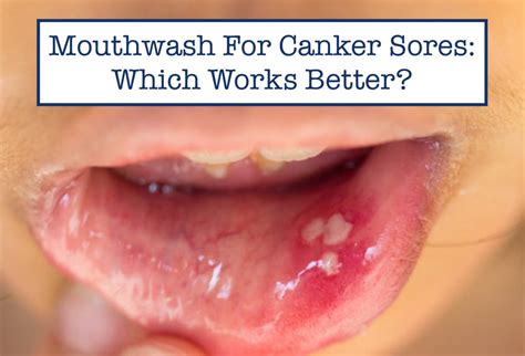 Mouthwash For Canker Sores Which Works Better