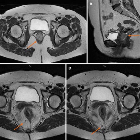 Pelvic Magnetic Resonance Imaging Scan With Intravenous Gadolinium