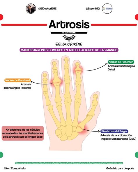 Mauricio Montelongo On Twitter Artritis Reumatoide Vs Artrosis