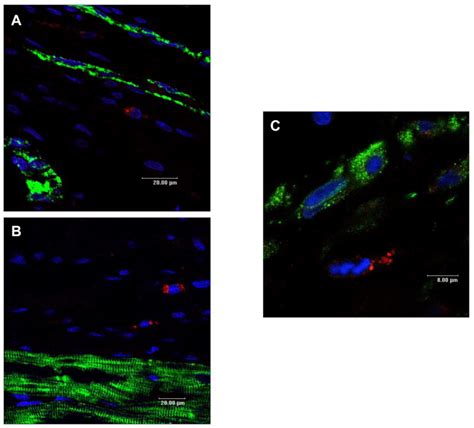 Intracoronary Infusion Of Autologous Mononuclear Cells From Bone Marrow