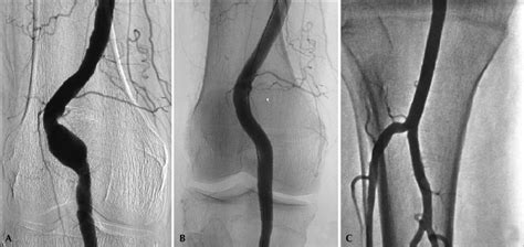 Endovascular treatment of popliteal artery aneurysm. (A) Fusiform... | Download Scientific Diagram