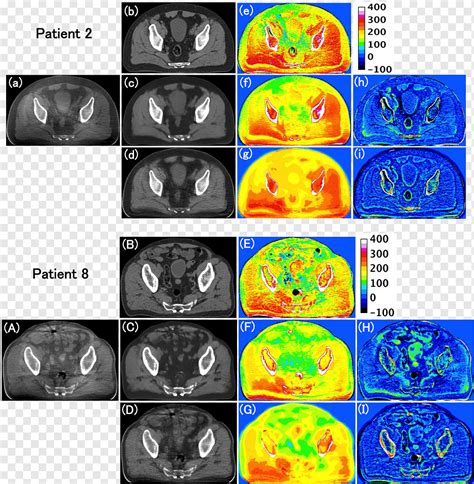 Radiografía De Tomografía Computarizada De Haz Cónico Tomografía