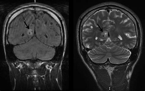 Imaging In Neurocysticercosis Practical Neurology