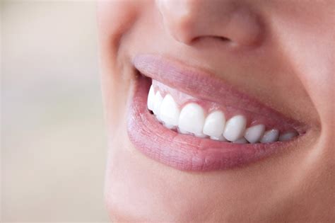 The Dental Veneer Process A Quick Summary Of What You Need To Know