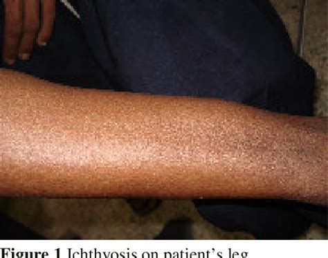 Figure From Overlapping Syndromes Keratosis Follicularis Spinulosa