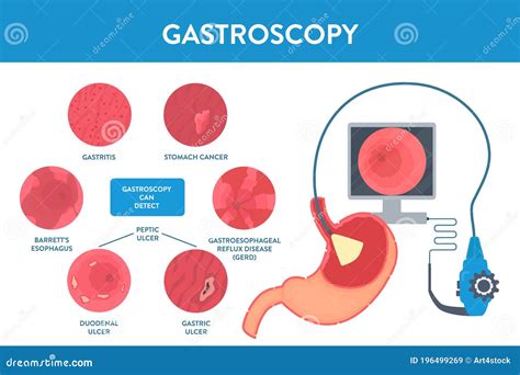 Gastroscopy Procedure of Stomach Examination with Endoscope Stock Vector - Illustration of ...