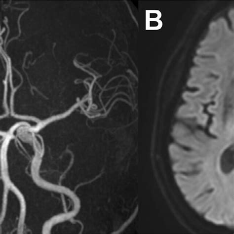 Post Procedural Imaging A Magnetic Resonance Angiography Performed Download Scientific