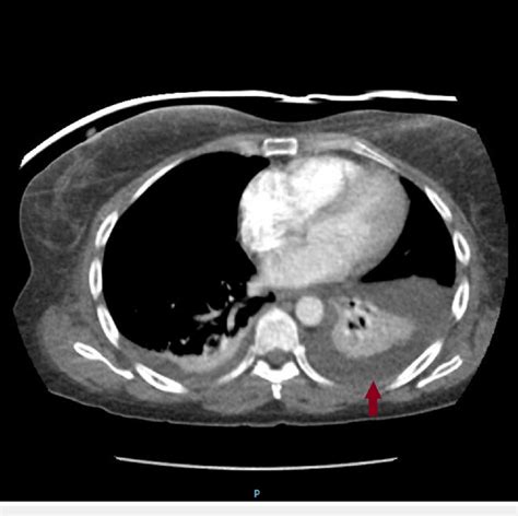 Pleural Effusion On Ct Scan