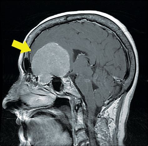 A Brain Tumor: October 2015