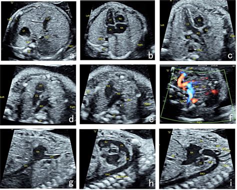 Fetal Heart Anatomy Ultrasound