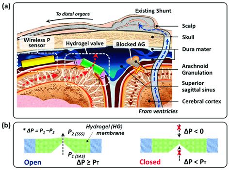 A Illustration Of Alternative Cerebrospinal Fluid Csf Draining