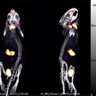 Side And Anterior PET CT Maximum Intensity Projections Of A Normal