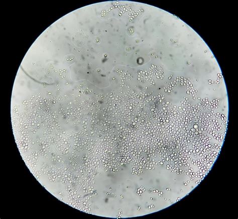 Premium Photo Budding Yeast Cells In Patient Urine Uti Pyelonephritis Or Cystitis Analyze By