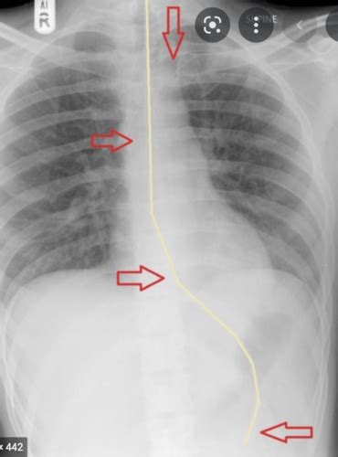 Enteral Parenteral Nutrition Flashcards Quizlet