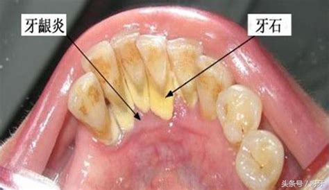 一不小心摳掉了牙結石？教你一招怎樣處理 每日頭條