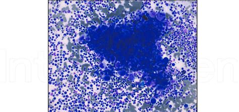 Bone Marrow Aspirate Smear From A Case Of Chronic Phase Cml Showing